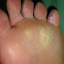 足蹠蠹蝕症　常與香港腳混淆 | 高雄林政賢皮膚科診所