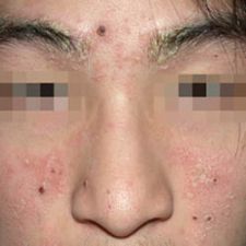 惱人的「脂漏性皮膚炎」 | 高雄林政賢皮膚科診所