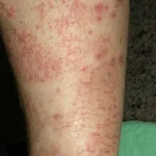 冬季癢,冬季濕疹,乾燥性皮膚炎,缺脂性皮膚炎,皮膚乾,乾癢