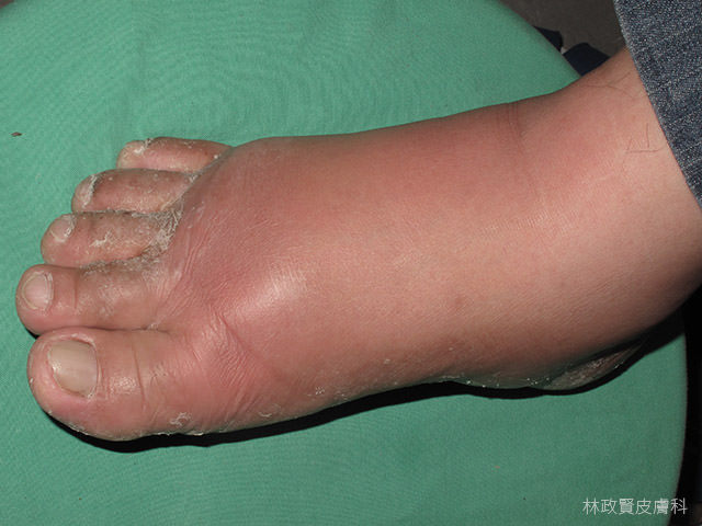 cellulitis,蜂窩組織炎