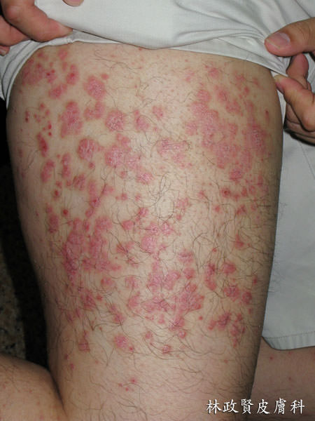 乾癬,魚滴狀乾癬,尋常性乾癬,psoriasis,guttate psoriasis