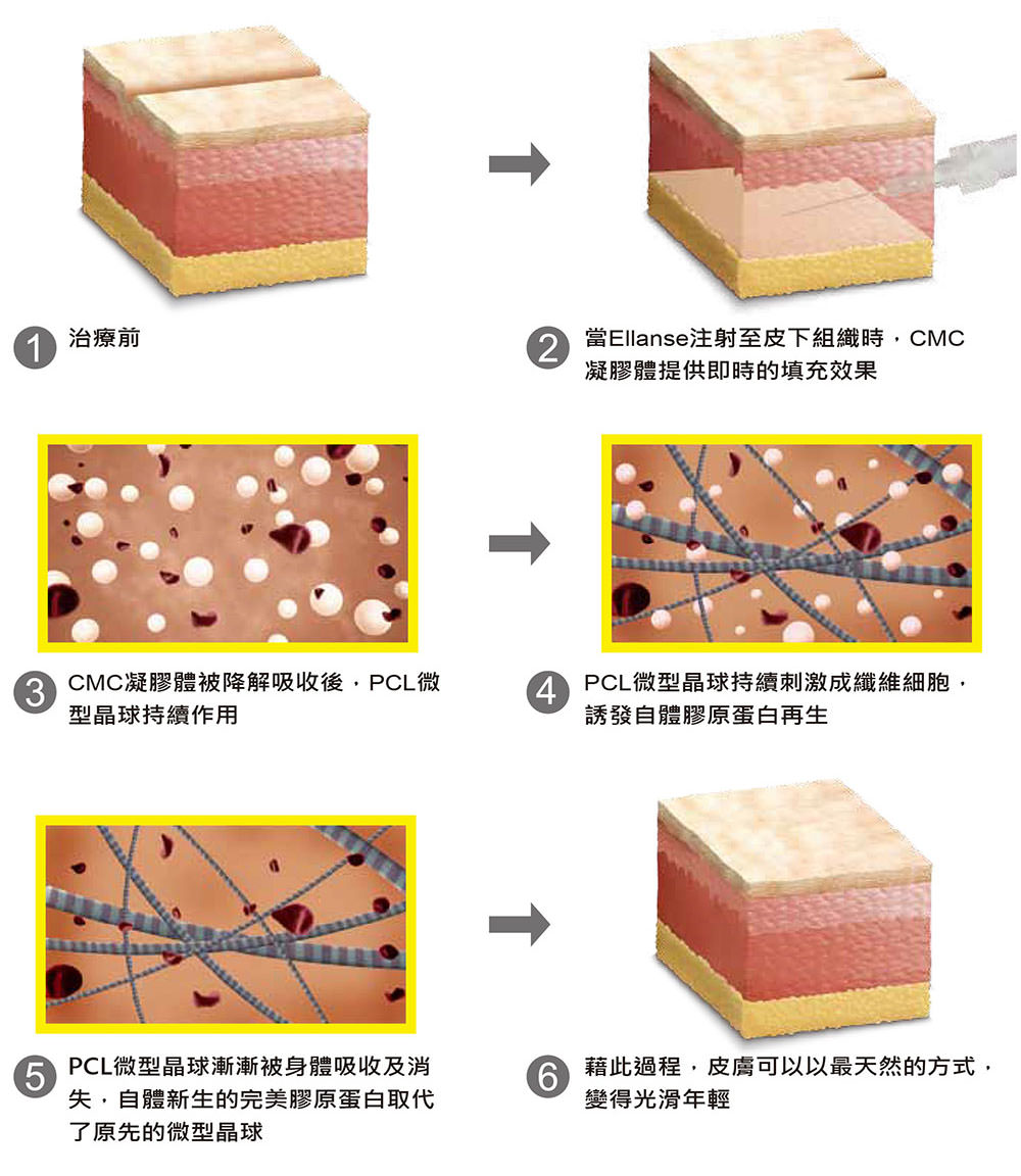 ellanse, 伊蓮絲, 伊戀詩