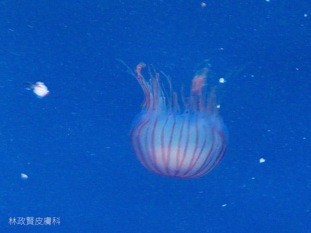 水母皮膚炎，jellyfish dermatitis