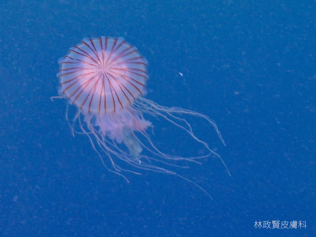 水母皮膚炎，jellyfish dermatitis