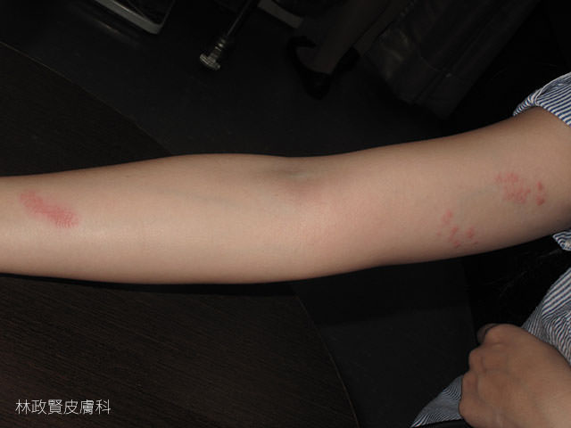 水母皮膚炎，jellyfish dermatitis