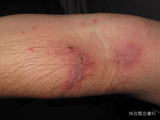 隱翅蟲皮膚炎,paderous,dermatitis