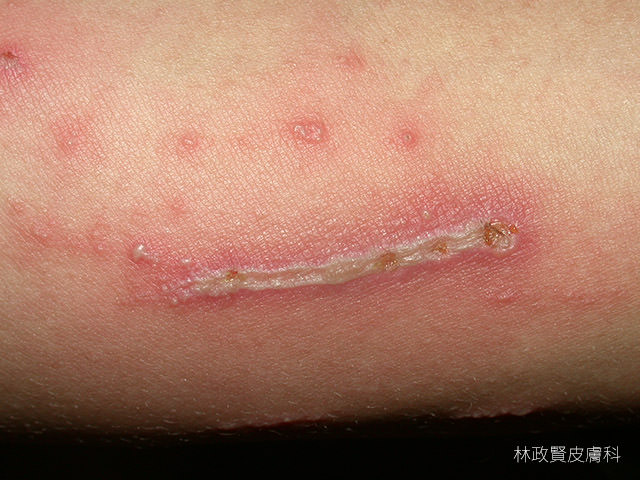 隱翅蟲皮膚炎,paderous,dermatitis