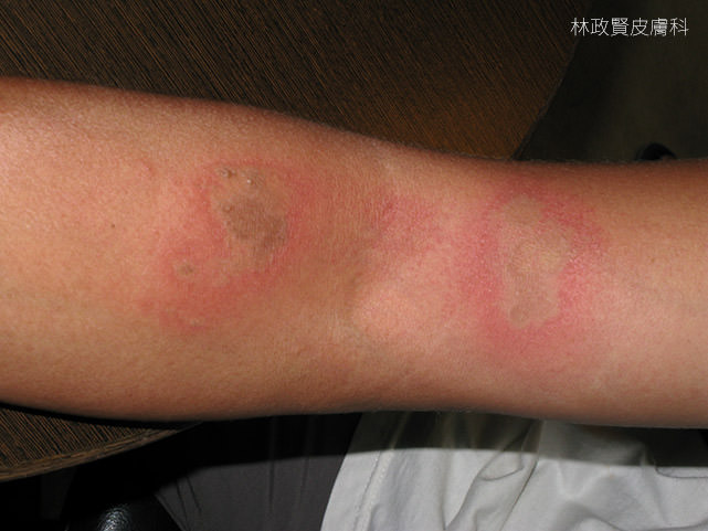 隱翅蟲皮膚炎,paderous,dermatitis