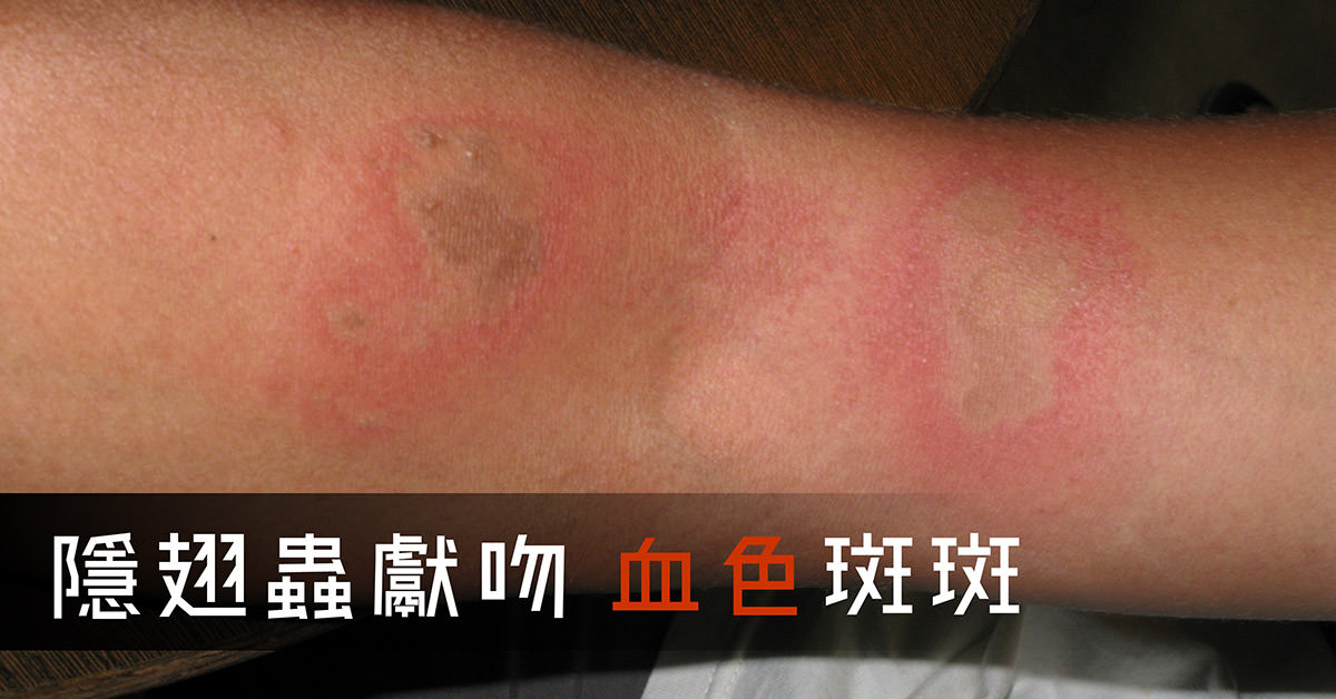 隱翅蟲皮膚炎,paderous,dermatitis