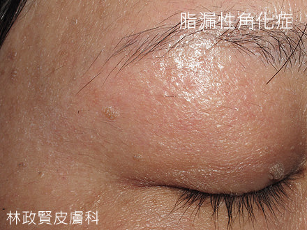 脂漏性角化症,老人斑,seborrheic,keratosis,扁平疣