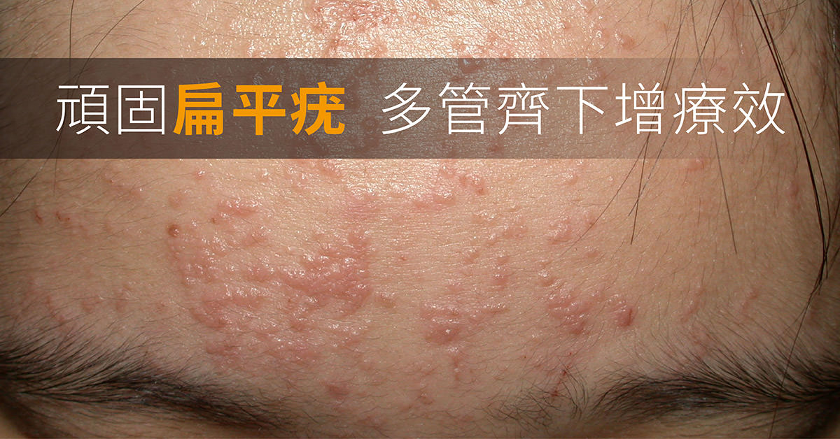 扁平疣,病毒疣,aldara,veregen,imiquimod,液態氮,脈衝染料雷射,pulsed,dye,laser,