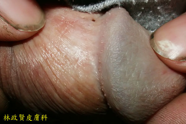 陰莖珍珠樣丘疹,pearly penile papule,PPP