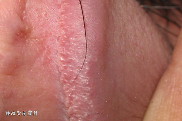 陰莖珍珠樣丘疹,pearly penile papule,PPP