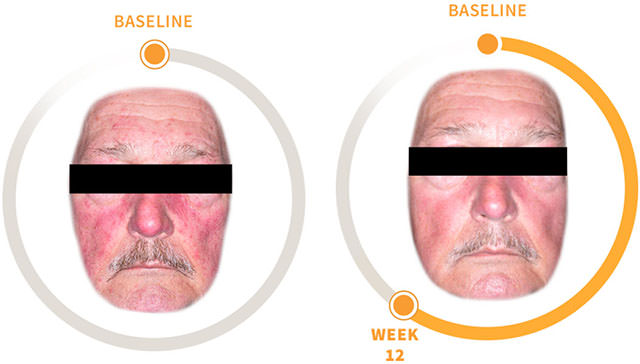 soolantra,ivermectin,舒立達,rosacea,酒糟