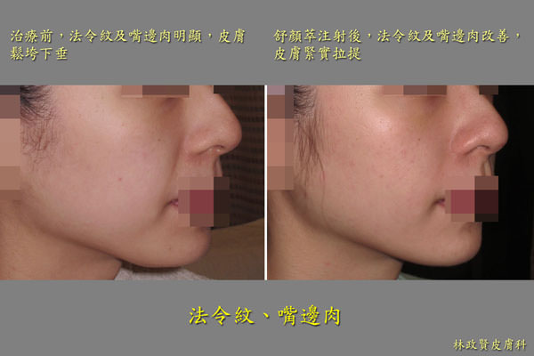 Sculptra,3D聚左旋乳酸,舒顏萃,微整形,微整型,返老還童,PLLA,液態拉皮,液體拉皮,童顏針,3D液態拉皮,3D童顏針