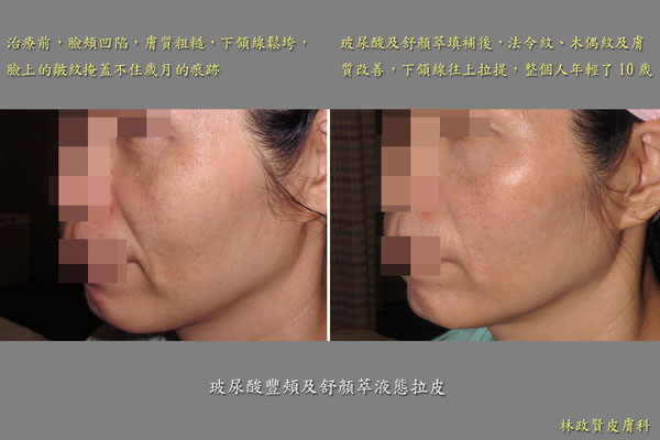 Sculptra,3D聚左旋乳酸,舒顏萃,微整形,微整型,返老還童,PLLA,液態拉皮,液體拉皮,童顏針,3D液態拉皮,3D童顏針