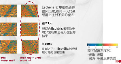 安緹斯,安提斯,安緹絲,anteis,esthelis,玻尿酸注射,微整形,微整型