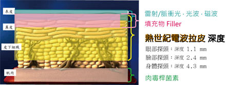 電波拉皮,電波拉皮價格,電波拉皮費用,熱世紀,第三代,無線電波拉皮