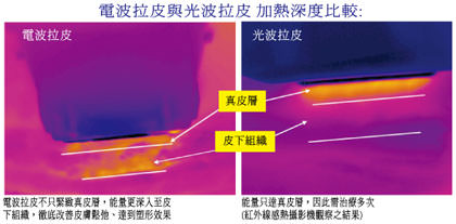 高雄電波拉皮,熱世紀,thermage,無痛電波拉皮,CPT,第三代電波拉皮