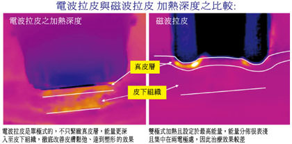 電波拉皮,電波拉皮價格,電波拉皮費用,熱世紀,第三代,無線電波拉皮