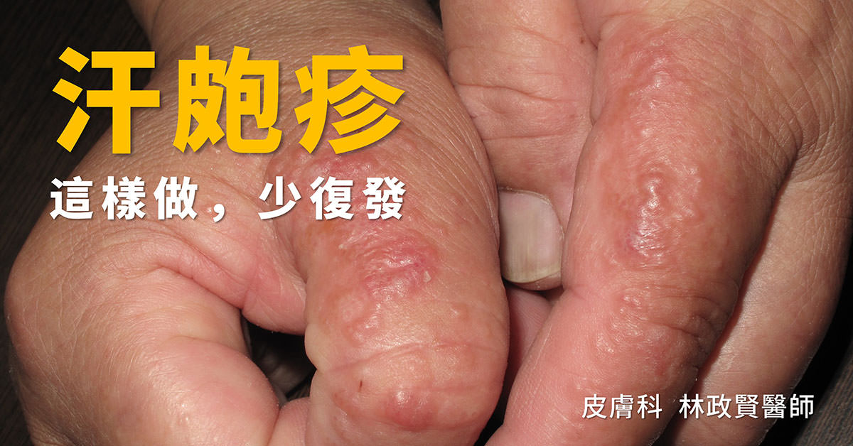 æ±ç°ç¹,æ±ç±ç¹,pompholyx,dyshidrotic eczema,æé¨æ¿ç¹,å¯è²´æ