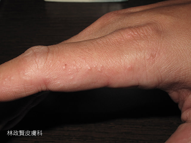 汗皰疹,汗疱疹,pompholyx,dyshidrotic eczema,手部濕疹