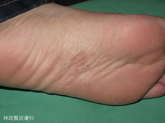 汗皰疹,汗疱疹,pompholyx,dyshidrotic eczema,手部濕疹