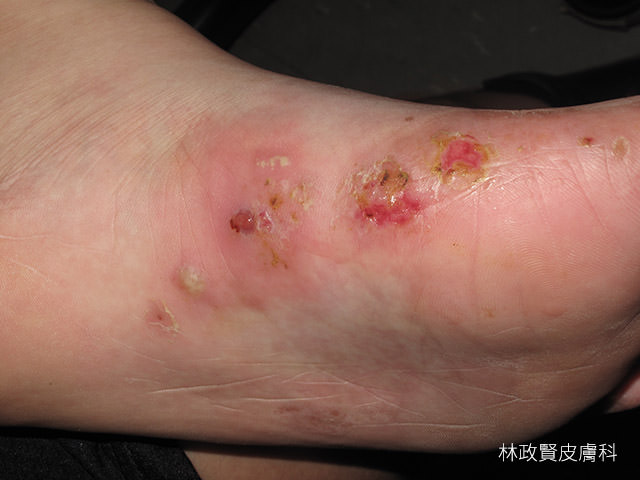 汗皰疹,汗疱疹,pompholyx,dyshidrotic eczema,手部濕疹