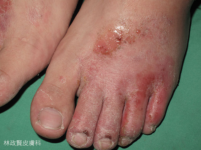 汗皰疹,汗疱疹,pompholyx,dyshidrotic eczema,手部濕疹