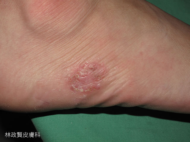 汗皰疹,汗疱疹,pompholyx,dyshidrotic eczema,手部濕疹