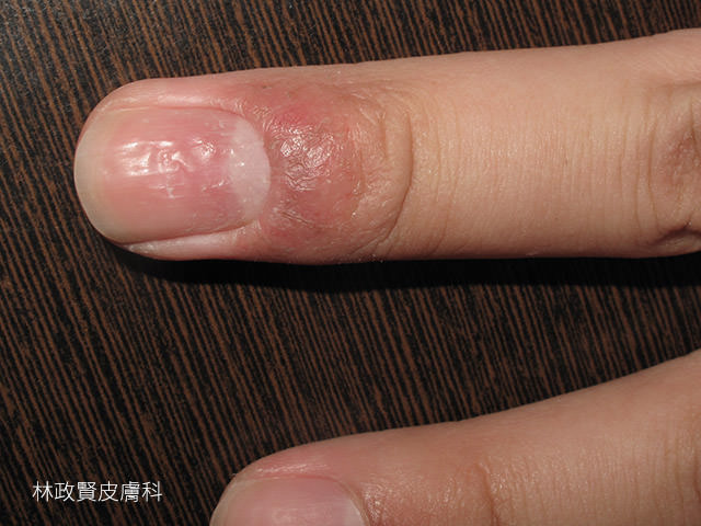 汗皰疹,汗疱疹,pompholyx,dyshidrotic eczema,手部濕疹