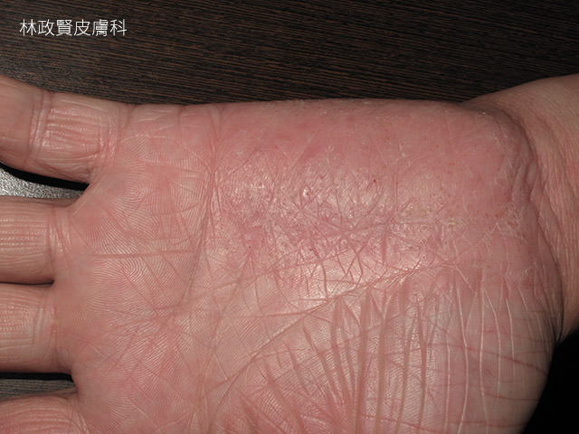 汗皰疹,汗疱疹,pompholyx,dyshidrotic eczema,手部濕疹