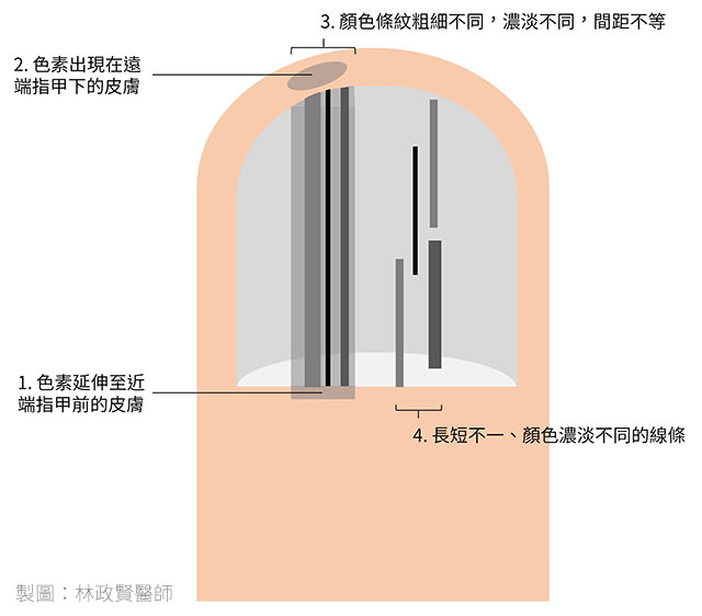 黑甲症,惡性,黑色素瘤,皮膚癌,黑色條紋,縱向黑甲症,指甲黑