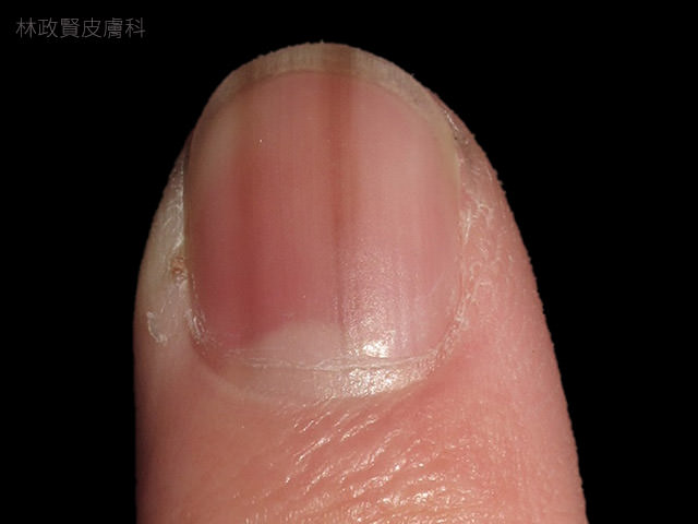 縱向黑甲症,惡性黑色素瘤,皮膚癌,指甲病變,melanoma,longitudinal melanonychia