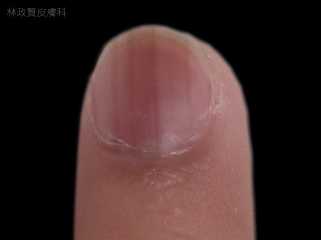 縱向黑甲症,惡性黑色素瘤,皮膚癌,指甲病變,melanoma,longitudinal melanonychia