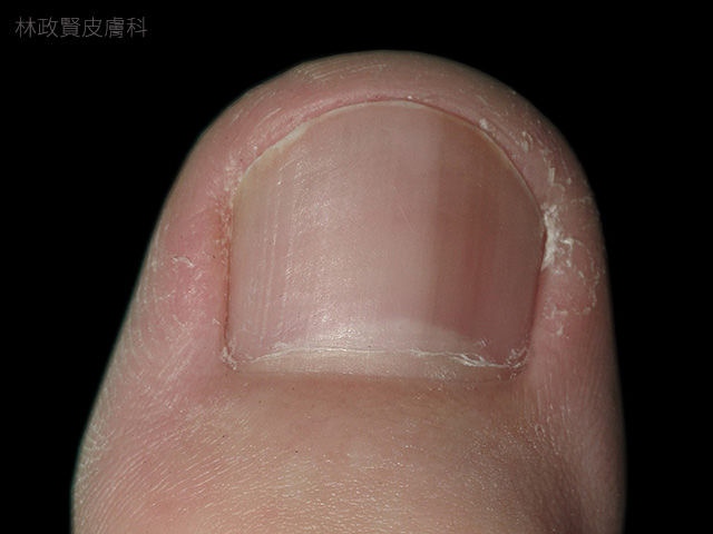 縱向黑甲症,惡性黑色素瘤,皮膚癌,指甲病變,melanoma,longitudinal melanonychia