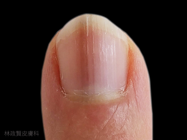 縱向黑甲症,惡性黑色素瘤,皮膚癌,指甲病變,melanoma,longitudinal melanonychia