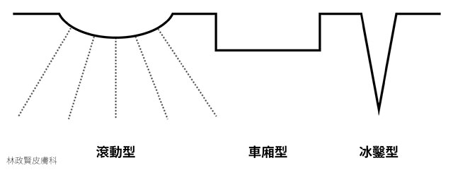 凹疤,凹洞,痘疤,皮秒雷射,汽化型雷射,汽化型雷射,微針滾輪,prp,飛梭雷射,picolaser,picosure,picoway,discovery,pico,picoq