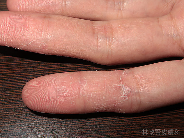 汗皰疹,汗疱疹,pompholyx,dyshidrosis,dyshirotic,eczema,hand,dermatitis,富貴手,手部濕疹,溼疹