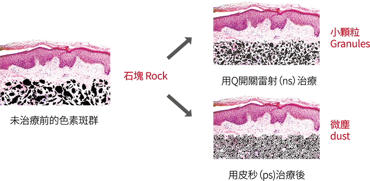 探索皮秒,discovery,pico,皮秒雷射,picolaser,picosure,picoway,picoq,pico4+