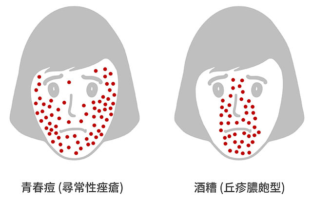 酒糟,酒渣,玫瑰斑,rosacea,臉潮紅,丘疹,膿皰,botox,肉毒桿菌,dysport,xeomin脈衝染料雷射,mirvaso,soolantra