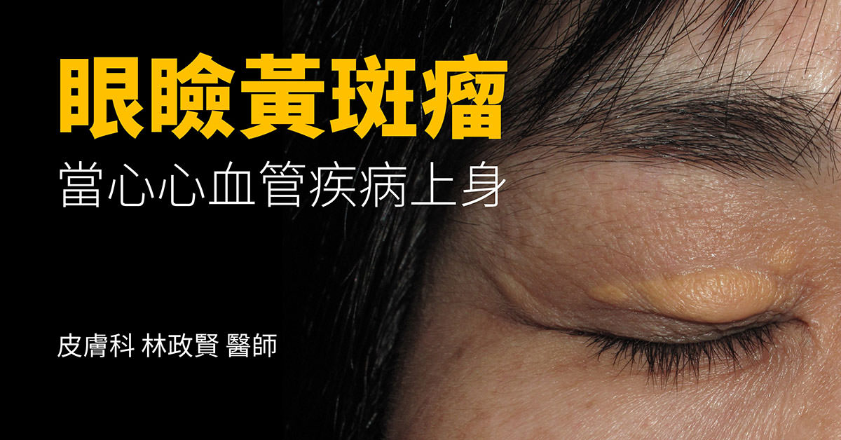 xanthelasma,眼瞼黃斑瘤,眼瞼黃色瘤,三氯醋酸,雷射,冷凍,手術