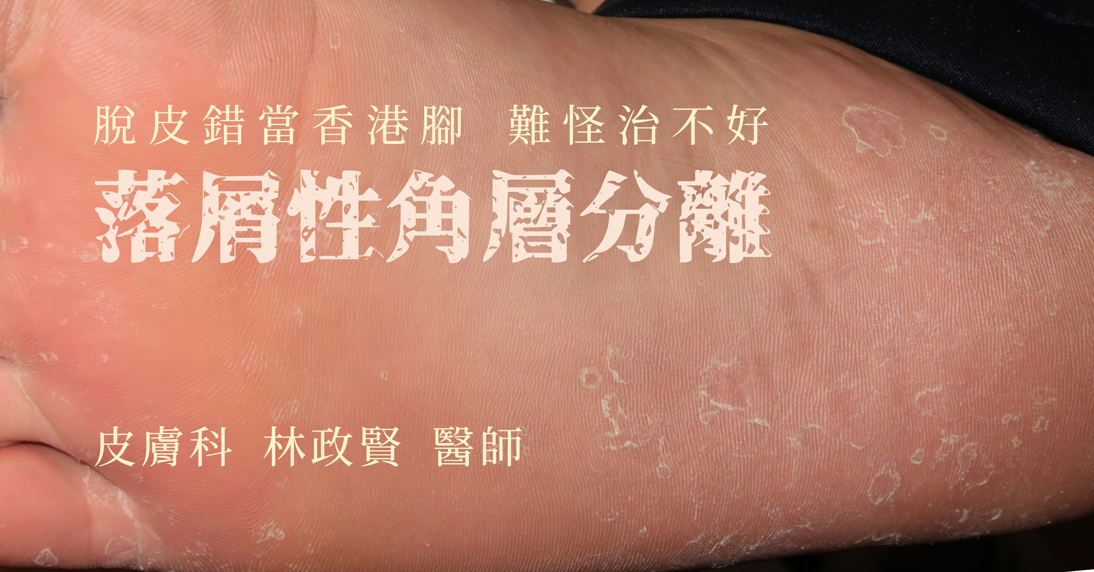 落屑性角層分離,剝脫性角質鬆懈症,keratolysis exfoliativa,香港腳,汗皰疹,手癬