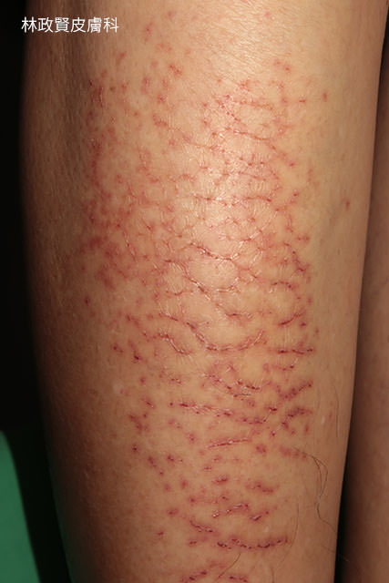 冬季癢,冬季濕疹,冬季溼疹,乾燥性皮膚炎,乾燥性濕疹,xerosis,xerotic,dermatitis,eczema,asteatotic,hiemalis