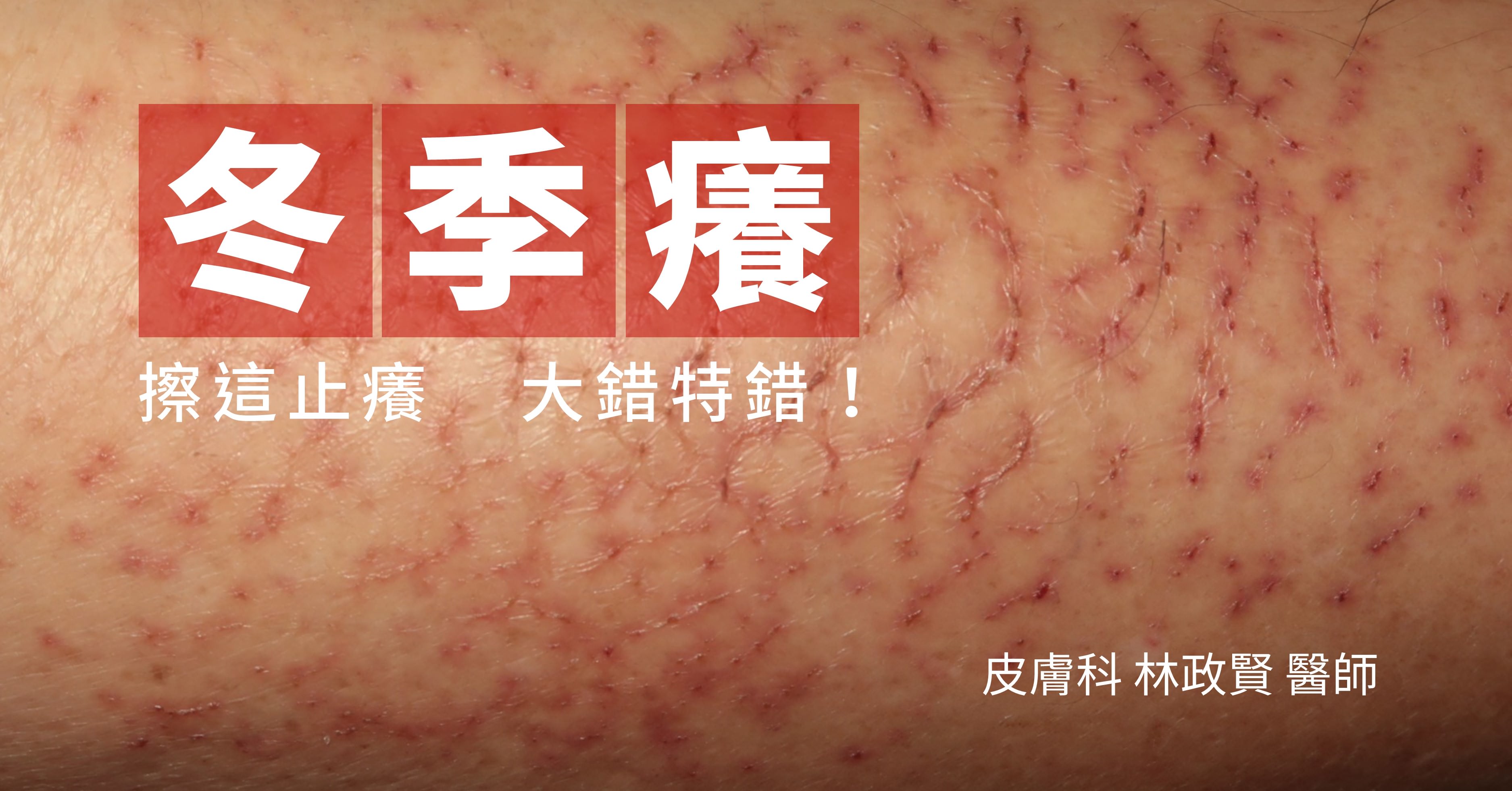 冬季癢,冬季濕疹,冬季溼疹,乾燥性皮膚炎,乾燥性濕疹,xerosis,xerotic,dermatitis,eczema,asteatotic,hiemalis