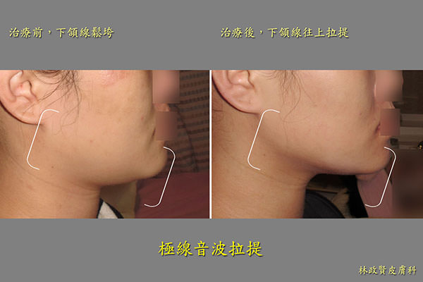 極線音波拉皮,ulthera,雙下巴,ultherapy