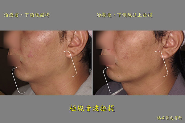 極線音波拉皮,ulthera,雙下巴,ultherapy