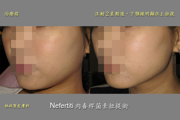 肉毒桿菌拉提,botolift,nefertiti,platysma,botox,xeomin,dysport