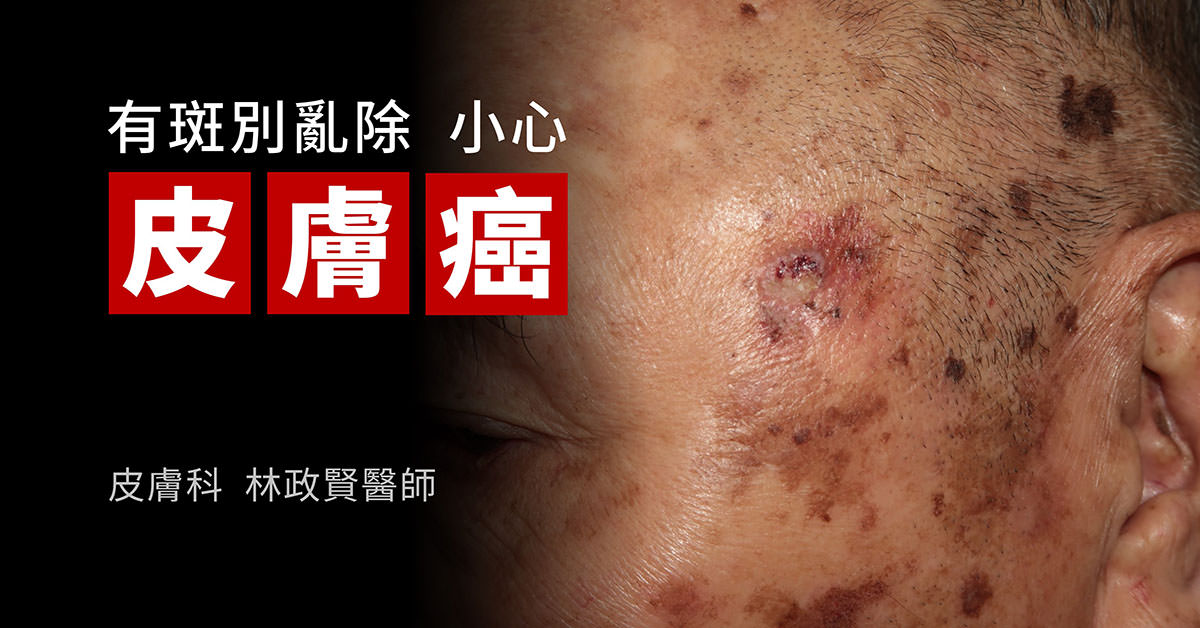 皮膚癌,skin cancer,雷射除斑,鱗狀細胞癌,squamous cell carcinoma,日光性角化症