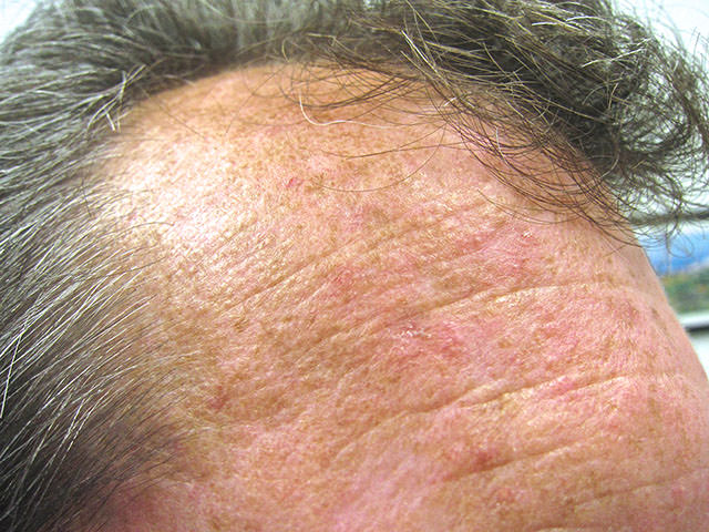 日光性角化症,actinic keratosis